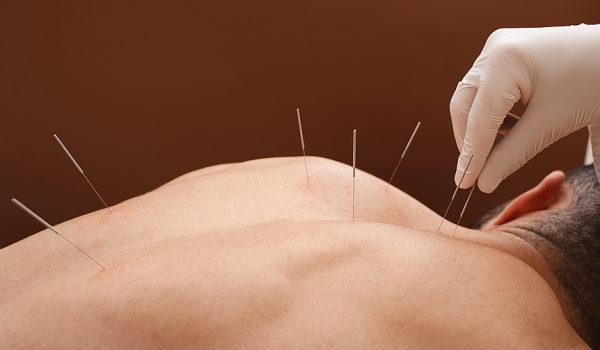 Everything You Need to Know About Acupuncture